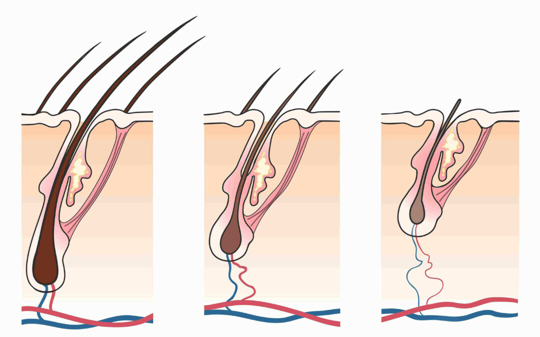 Hair Miniaturization (A Sign of Androgenic Alopecia)