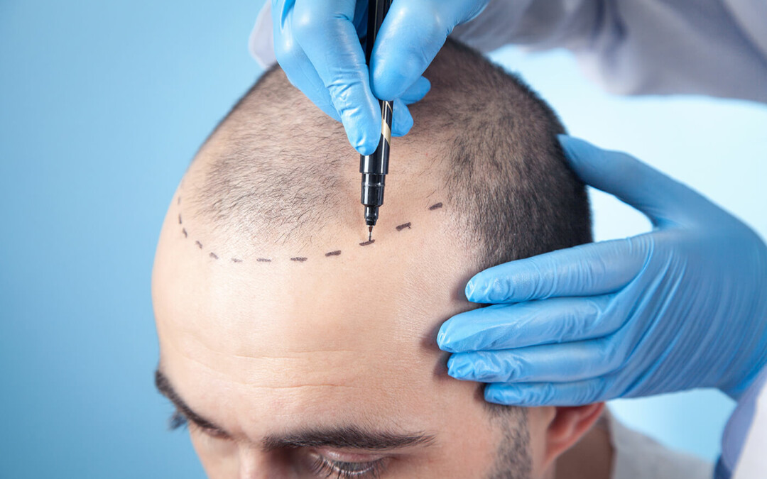 How Much Does a Hair Transplant Cost (Update for 2023)