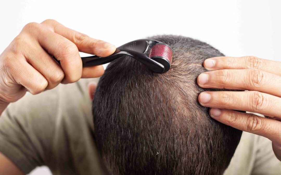 Using a Dermaroller for Hair Growth