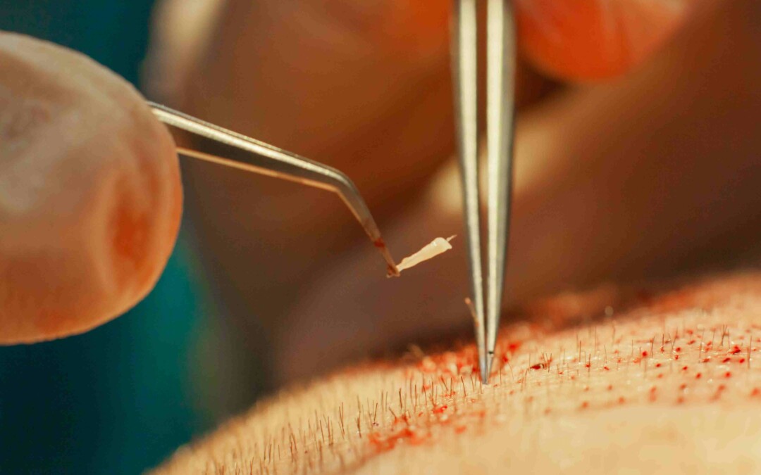 Do Hair Restoration Surgeries Leave Hair Transplant Holes?