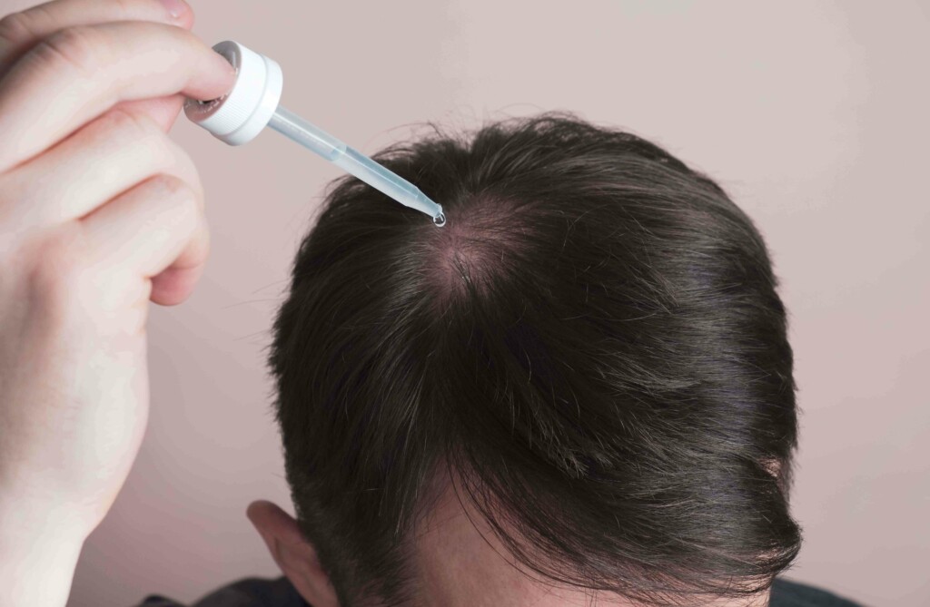 A close up of a man applying topical dutasteride to the balding crown of his head