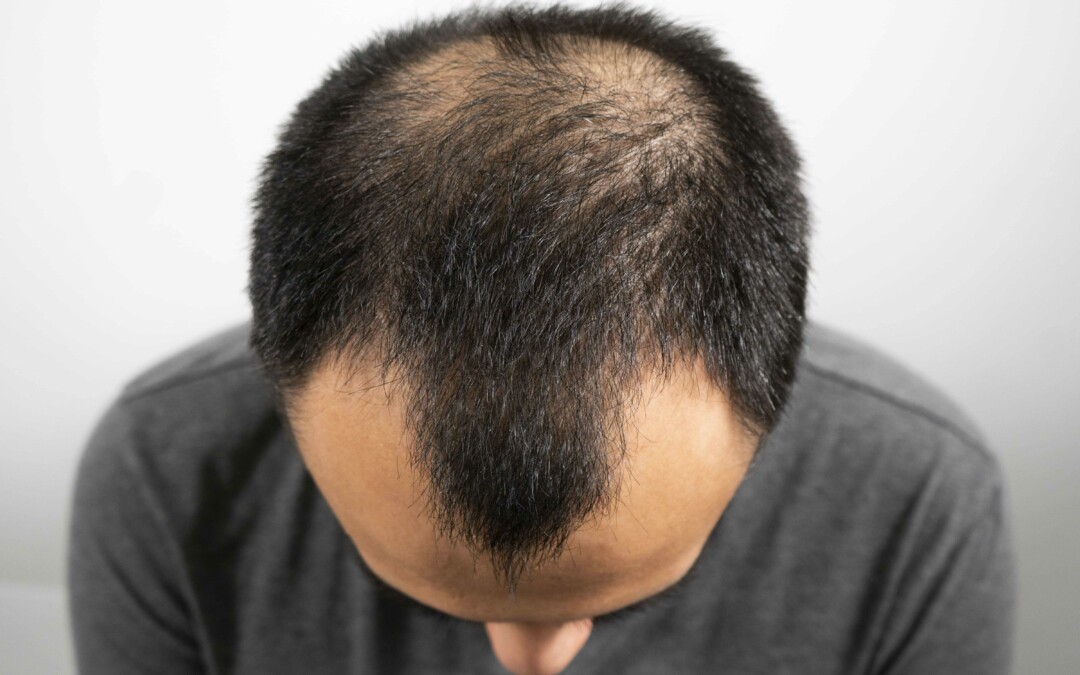 FDA-Approved Hair Loss Treatments for Androgenic Alopecia