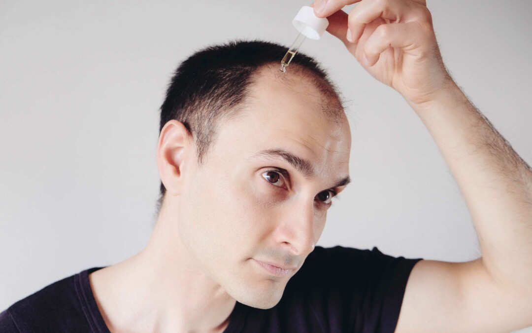 DLQ01: Dermaliq’s New Hair Loss Drug Starts Clinical Trials