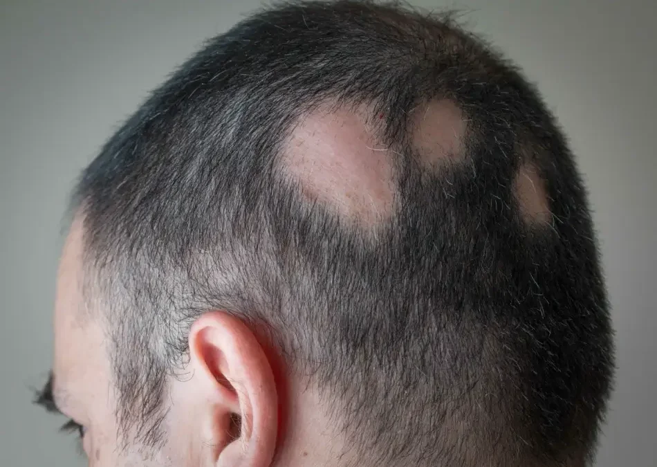 Will Ritlecitinib Be the Next FDA-Approved Alopecia Drug?
