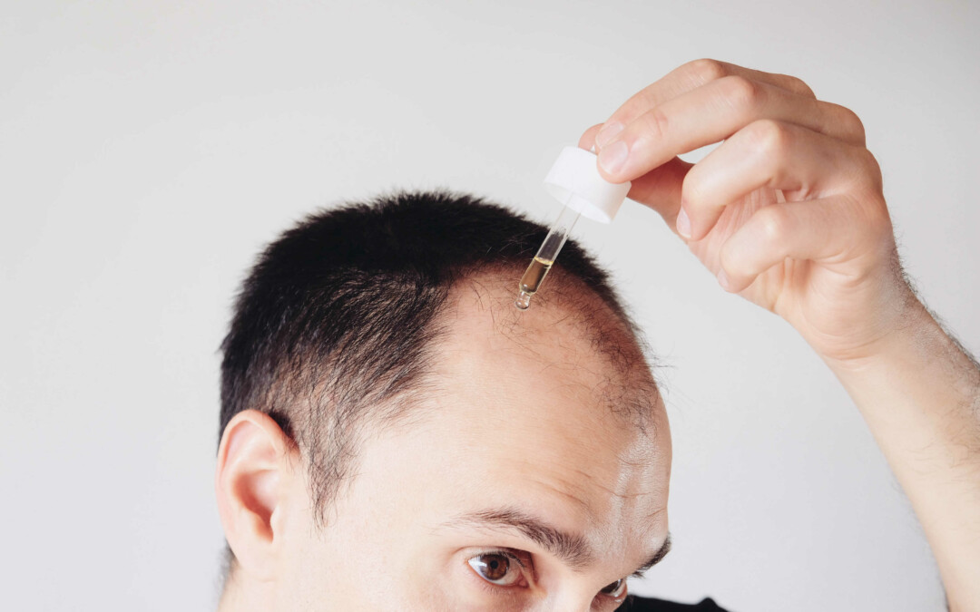 Breezula® Phase 3 Clinical Trials for Male Pattern Hair Loss Begin