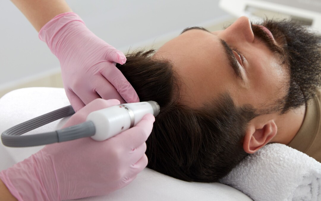 Can Fractional Non-Ablative Laser Therapy Treat Alopecia?