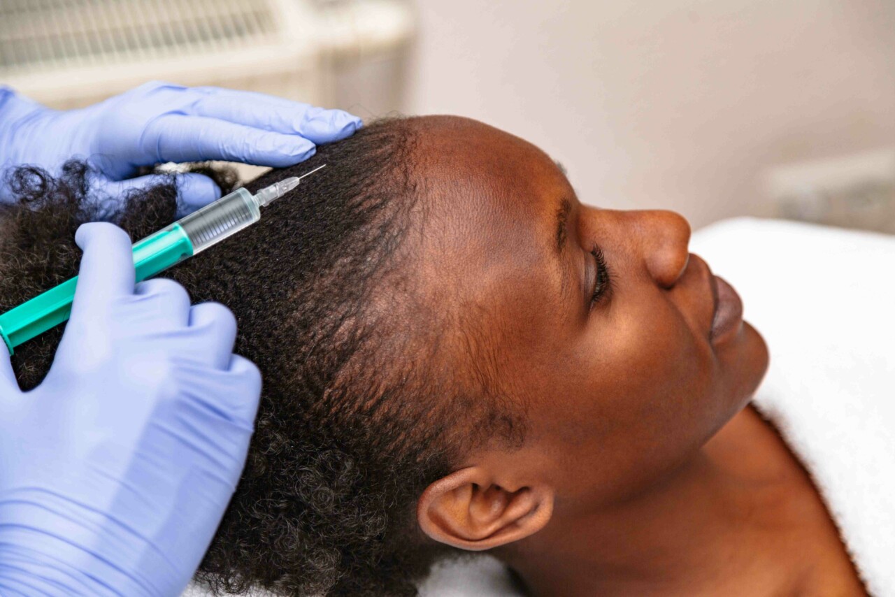 Can you regrow your hair after scarring alopecia?