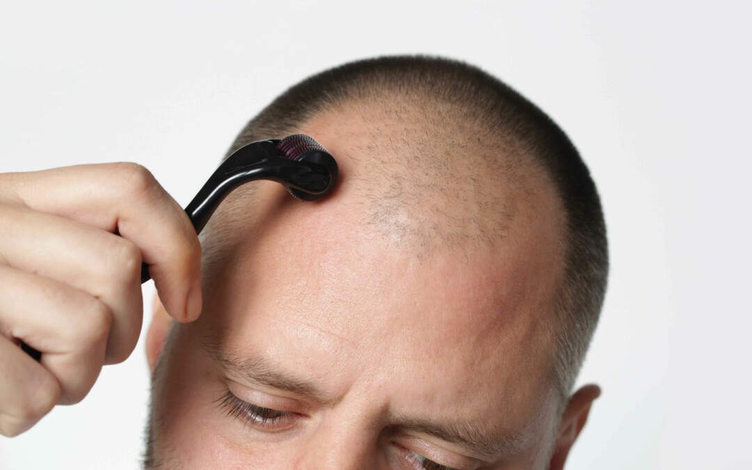 Microneedling at Home for Hair Loss