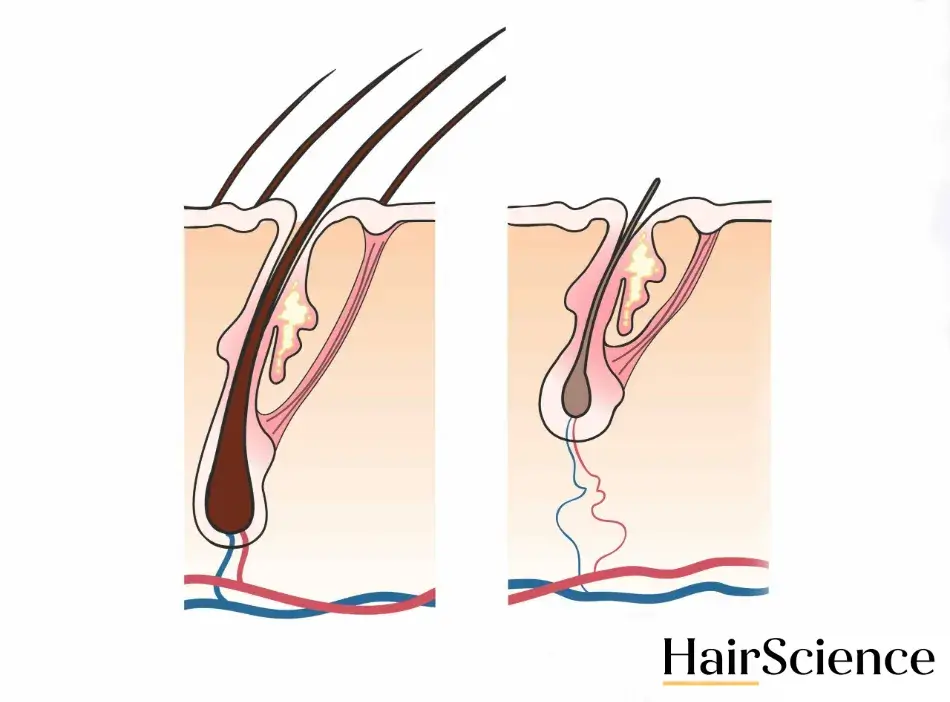 Diagram showing the difference between vellus hair and normal hair follicles