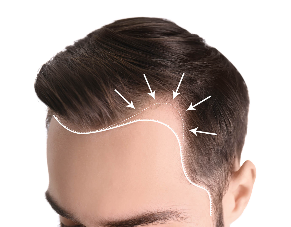 Close-up of a man's temple area with arrows and dotted lines showing a receding hairline as a sign of early-stage hair loss.