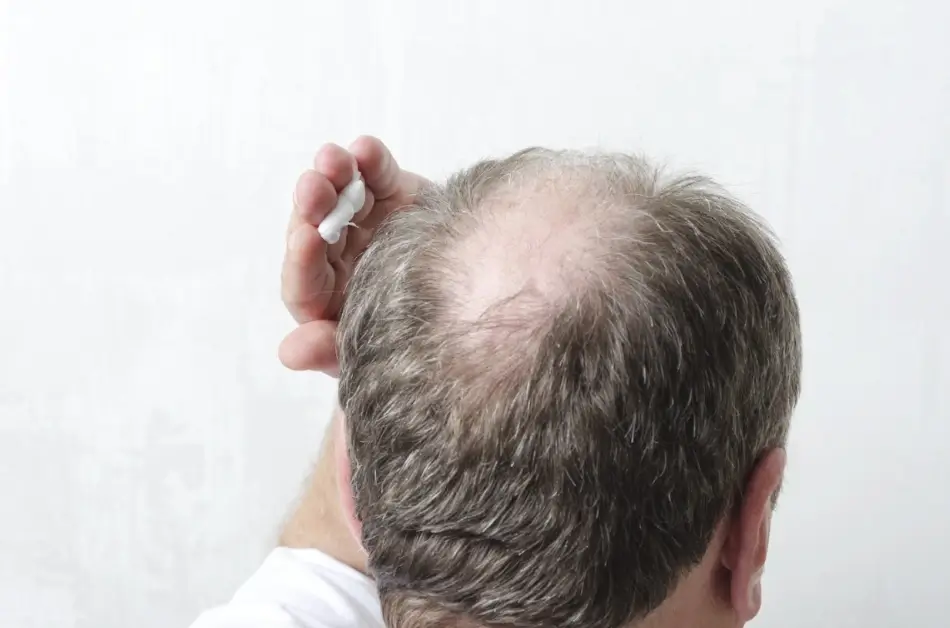 Man applying topical finasteride on his scalp